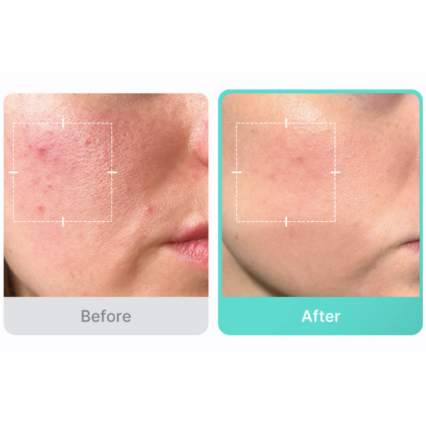 Medicube 16% Azelaic Acid Serum for Acne Relief 30ml