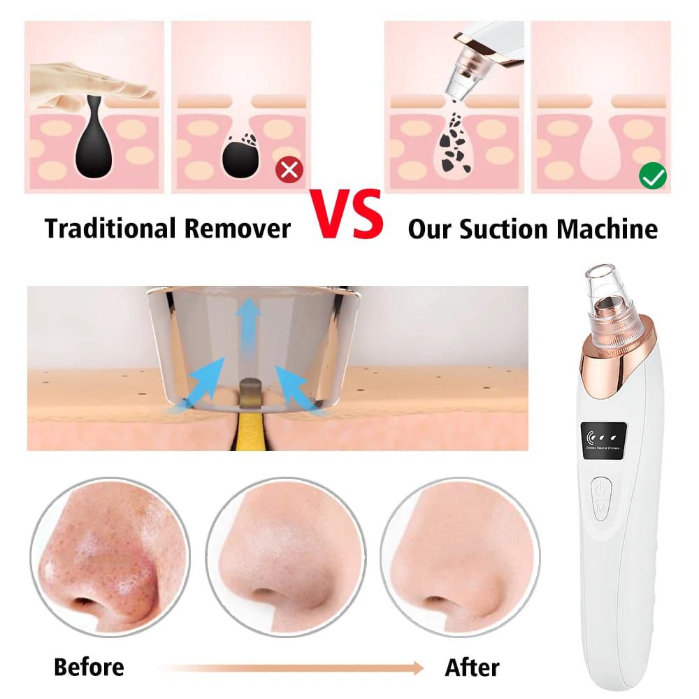 5-in-1 Electric Blackhead Remover Vacuum with LCD Screen