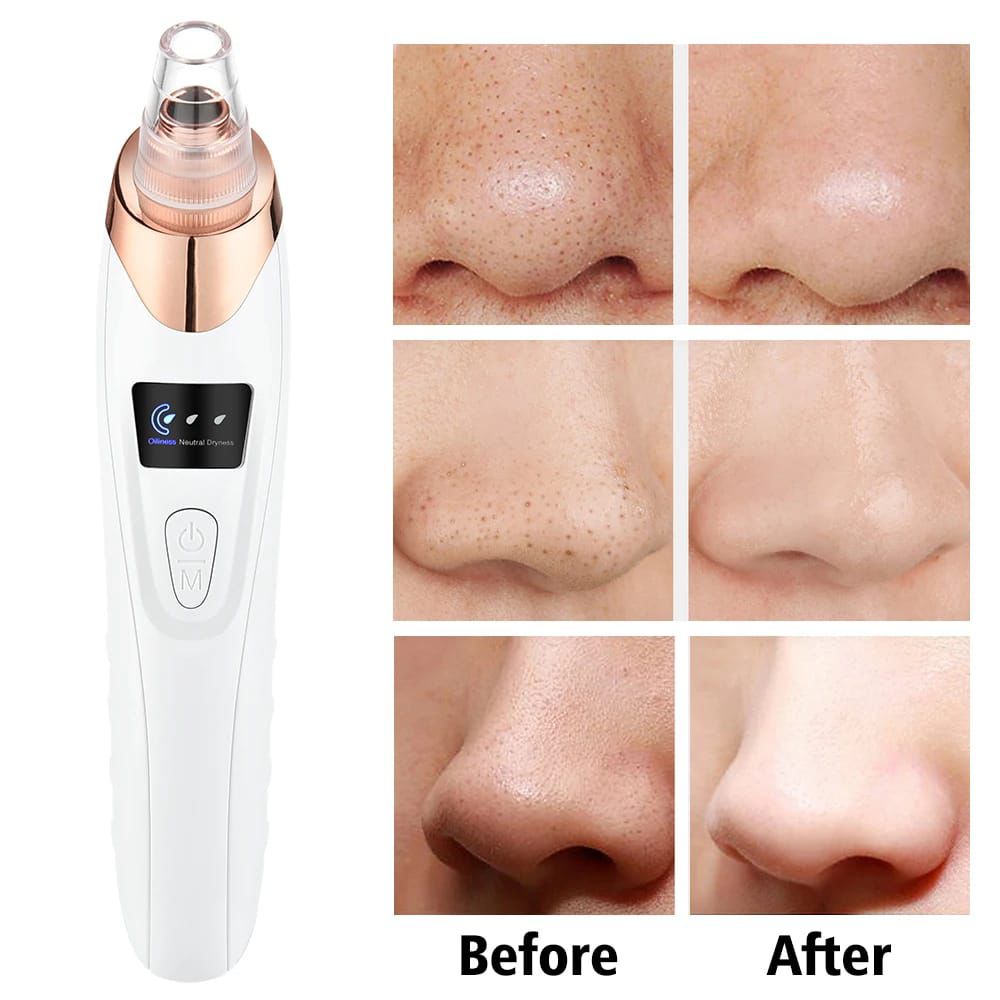 5-in-1 Electric Blackhead Remover Vacuum with LCD Screen