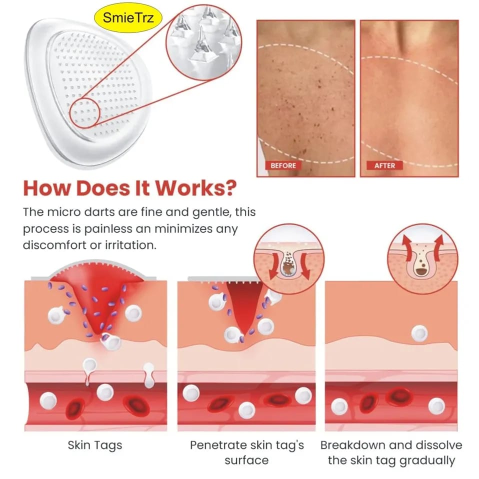 DermaSmooth Skin Tag Remover Patch – Fast & Easy Skin Tag Removal